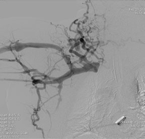 Image of central chest vein
