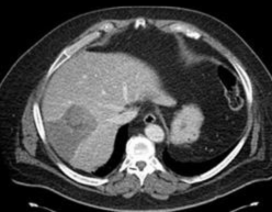 Image of radioembolization of live tumors