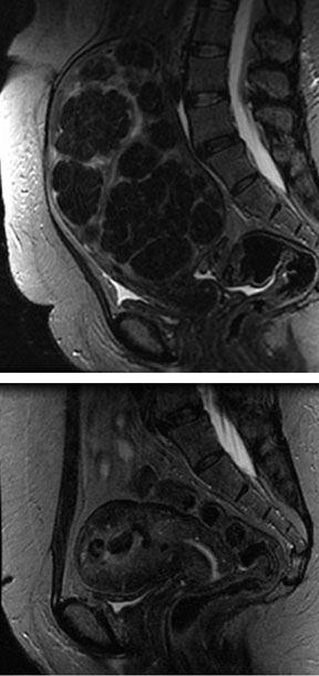 uterine-fibroid-embolization-(ufe)